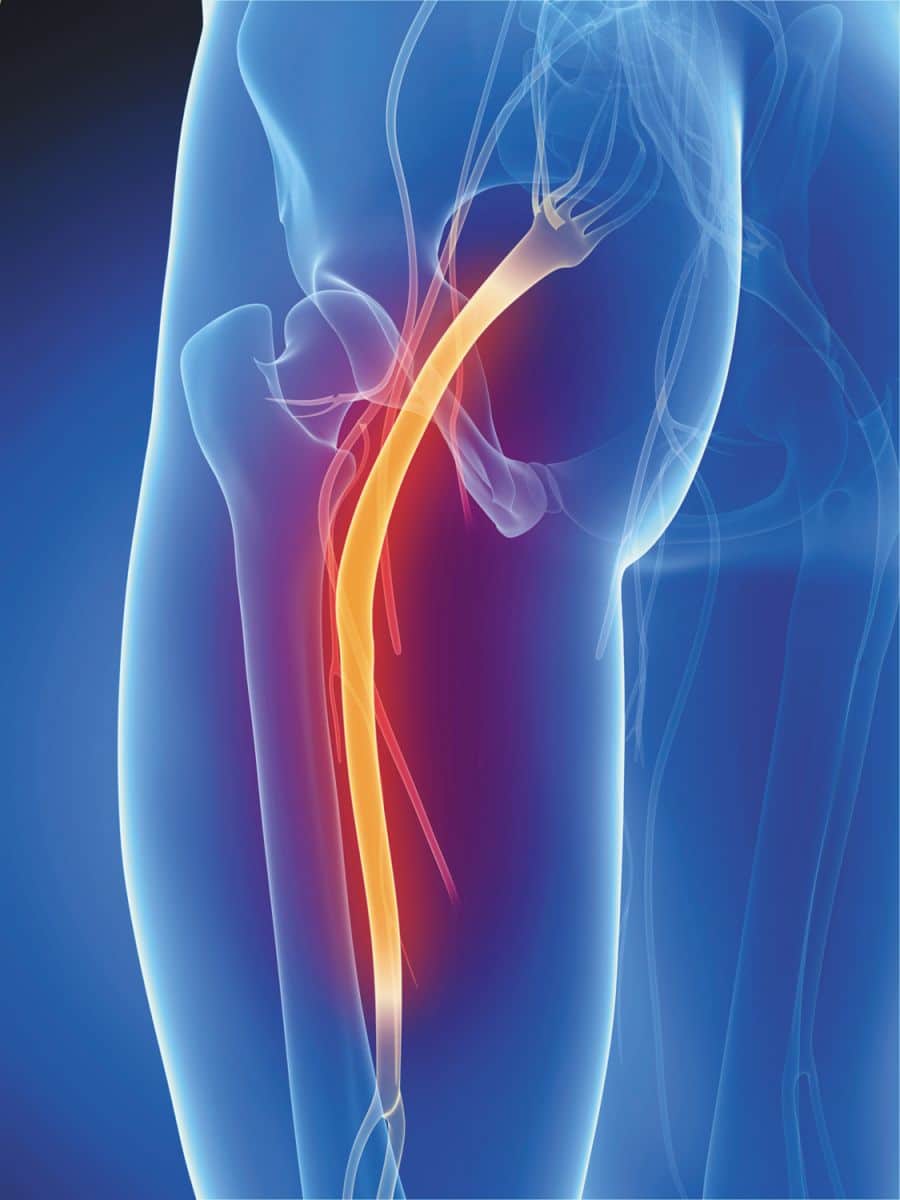 Mayo Clinic Q and A: Sciatica Treatment Options - Mayo Clinic News